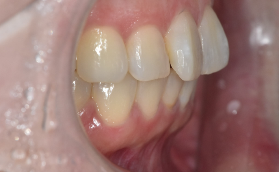 치아교정 재교정 다시 삐뚤어진 치아 원인과 해결방법은? 관련 이미지 3