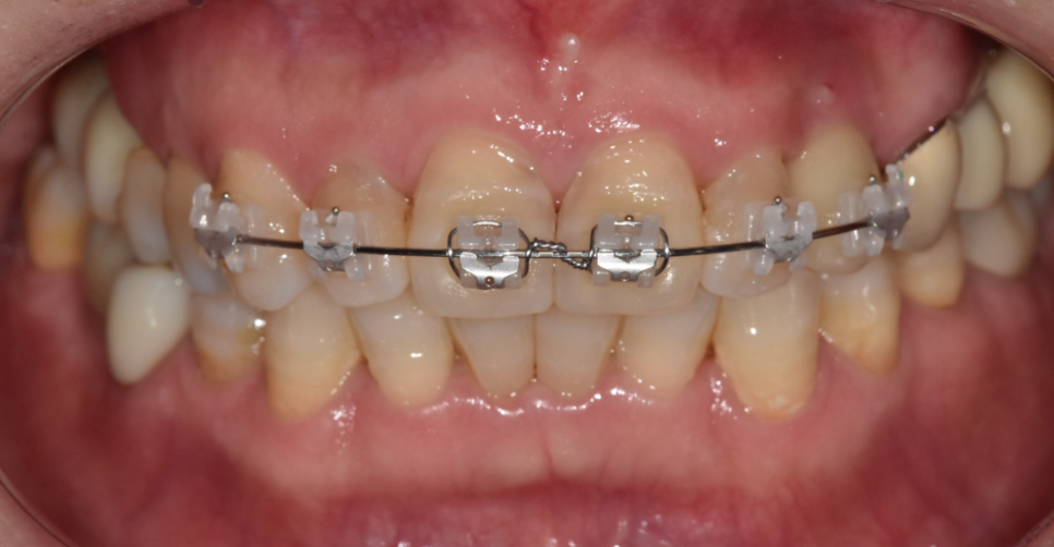 Orthodontic Bracket Debonding: Please Pay Attention If You Have Many Prosthetic Restorations image 2