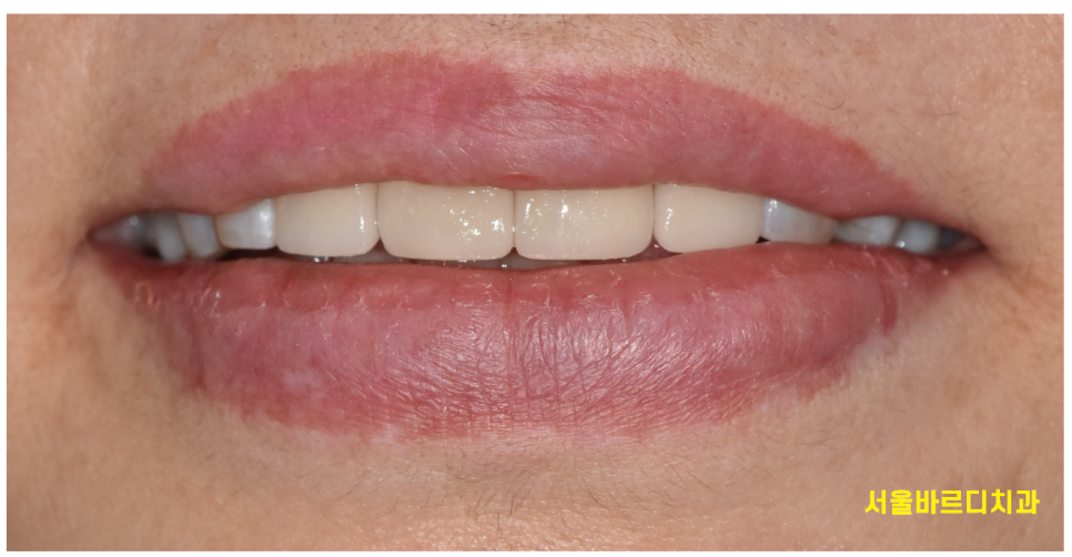 앞니 치아 사이 벌어짐 라미네이트로 컴플렉스 극복! 관련 이미지 7