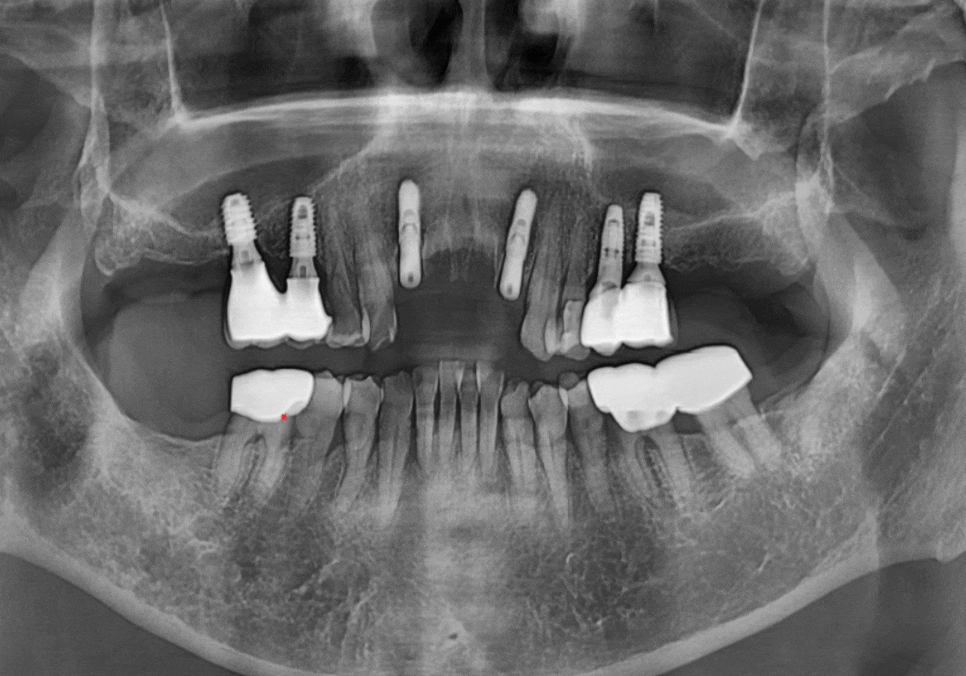 상일동역 치과 앞니 임플란트 기간 때문에 망설이신다면 꼭 보세요. 관련 이미지 13