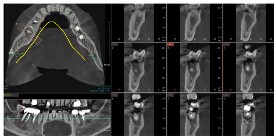 고덕동 치과 디지털 임플란트는 뭔가요? 뭐가 달라요? 관련 이미지 4