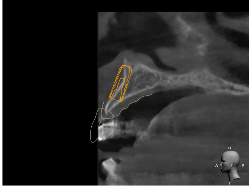 이 뽑고 바로 임플란트 심어도 될까요?? 관련 이미지 4