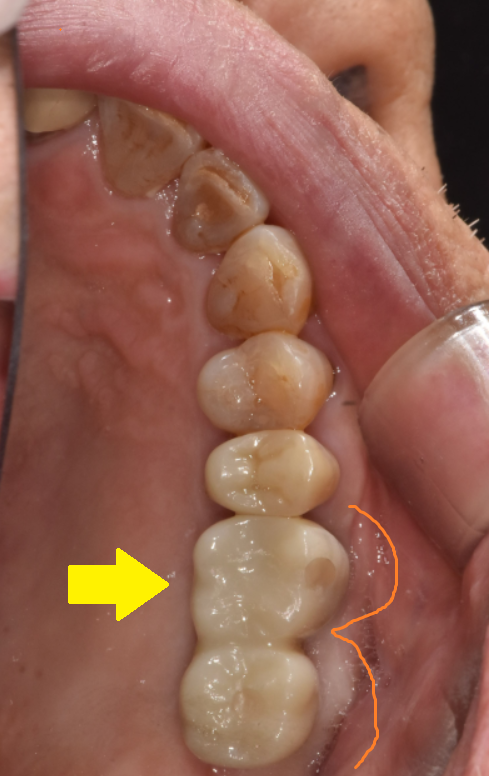 상일동 임플란트 치아 솟음으로 불편함을 느낄 때 관련 이미지 9