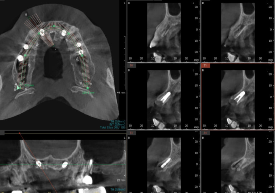 상일동역 치과 앞니 임플란트 기간 때문에 망설이신다면 꼭 보세요. 관련 이미지 7