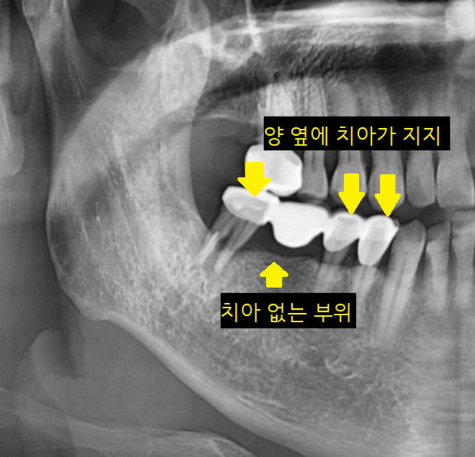 고덕동 임플란트 크라운 연결해서 만드는 이유는? 관련 이미지 3