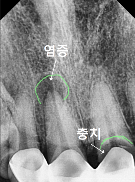 강동구 오래된 보철, 교체 시기는? 아프지 않은데 꼭 바꿔야 하나요? 관련 이미지 12