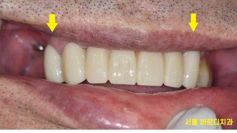 외국인 치과 진료 하악 전체 임플란트 7개 심어 12개 치아 만들기 관련 이미지 10