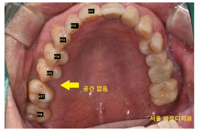 고덕역 근처 치과 브릿지와 임플란트 고민 중이신 분들 클릭하세요 관련 이미지 4
