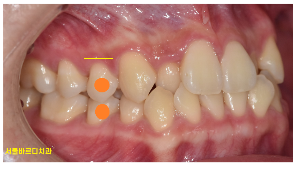 소구치 발치 교정 부작용은 없을까요?? 쌩니를 뽑는거라... 관련 이미지 4