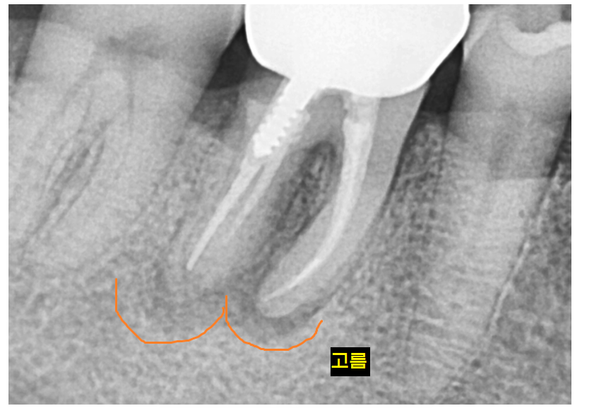Implant treatment is needed when a gum pimple or pus appears. image 3