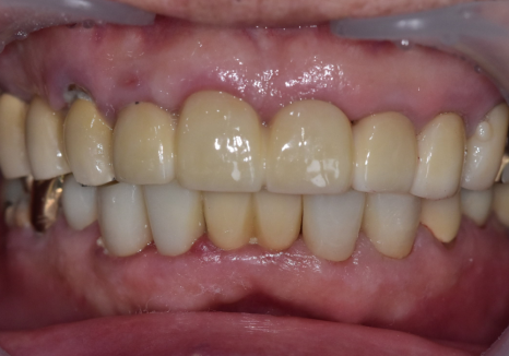 앞니 음식물 끼임, 왜 젊을 때보다 더 자주 발생하는 걸까요? 까맣게 변한 앞니 치료 사례 관련 이미지 15