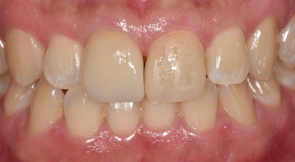 Gangdong-gu laminate failure and detachment: front teeth restored through retreatment image 7