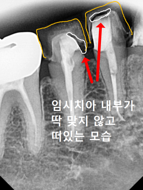 Honestly, Can an Unbroken Temporary Tooth Be Used Without a Crown? image 7