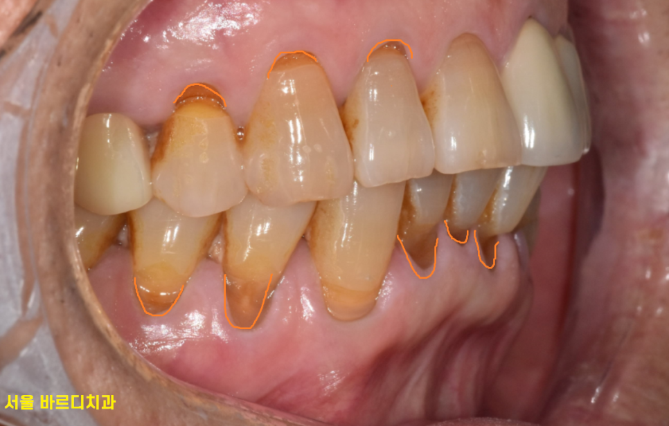 감일동 치과 어금니 시림 충치가 아닐 수도 있다? 임플란트 하게된 사연 관련 이미지 2
