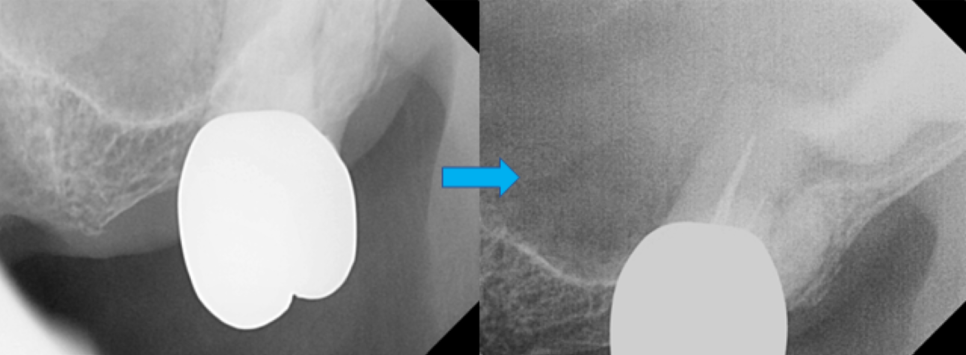 고덕동치과 서울바르디치과 전치부 및 구치부 임플란트 치료증례 #9 관련 이미지 19