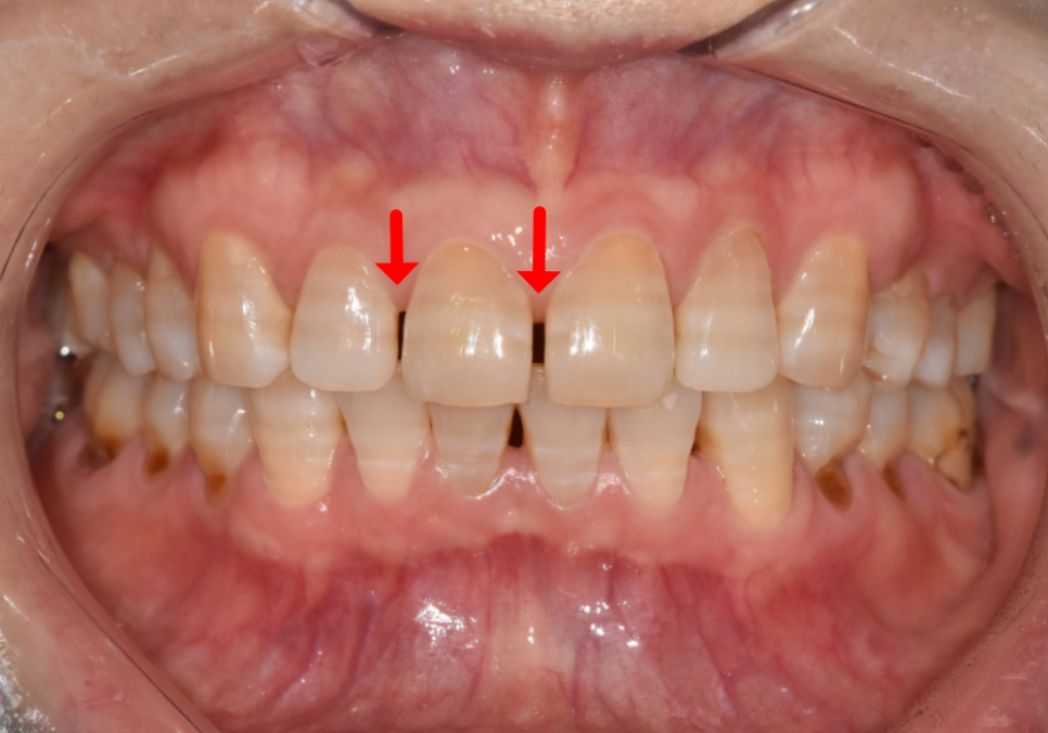 고덕동 무삭제 라미네이트, 실패 없이 하려면 꼭 확인할 3가지 관련 이미지 3