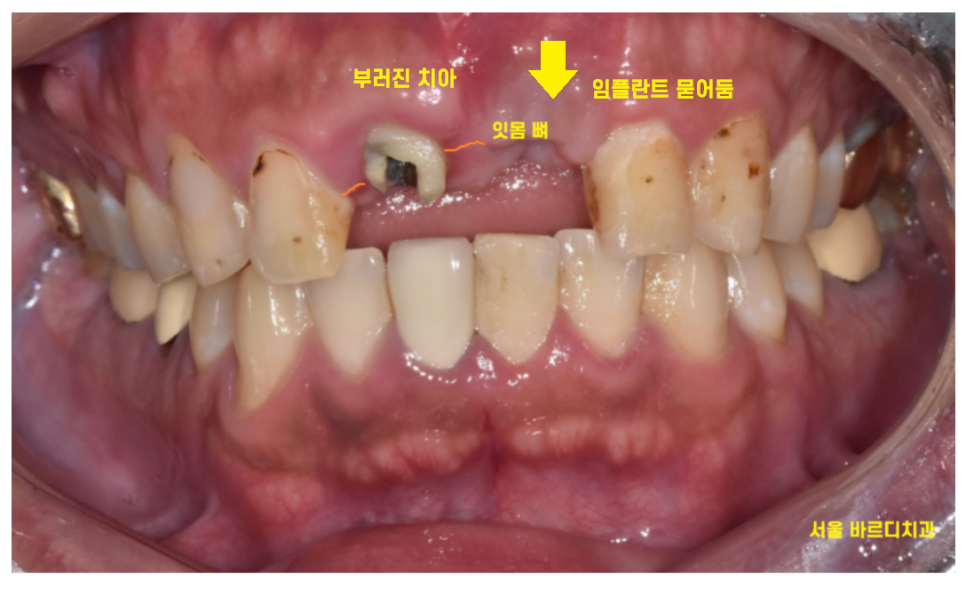 앞니 부러짐 손상이 커서 하남선동치과에서 임플란트 치료 관련 이미지 8