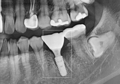 Honestly, Can an Unbroken Temporary Tooth Be Used Without a Crown? image 16