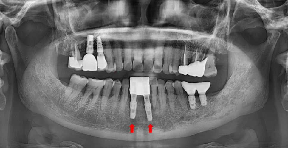 아래 앞니 임플란트 잇몸 염증 고름으로 인한 흔들림이 심해질때 관련 이미지 8