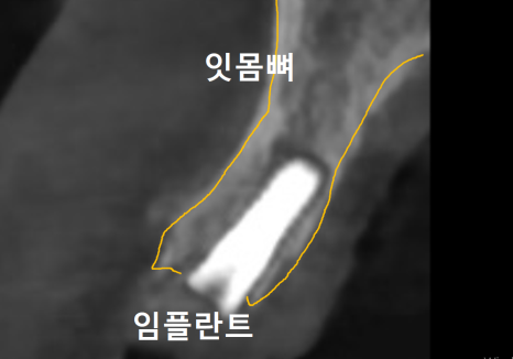 앞니 임플란트, 원내 기공소의 중요성을 아시나요? 관련 이미지 8