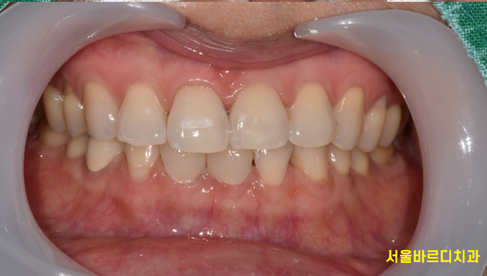 고덕동 치과에서 시행한 라미네이트와 치아 미백 과정 및 순서 관련 이미지 8