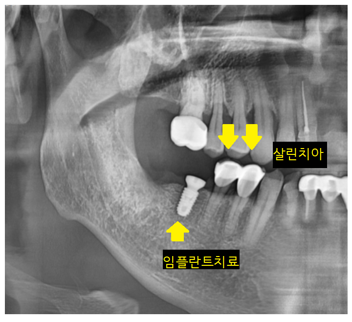 오래된 브릿지 보철 제거 후 고덕역 임플란트 교체 케이스 관련 이미지 6