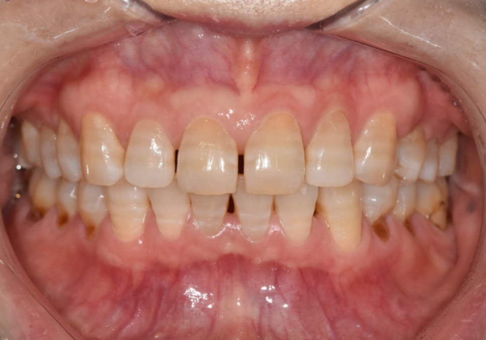 명일동 라미네이트 vs 크라운, 수명을 좌우하는 선택 기준 3가지 관련 이미지 5
