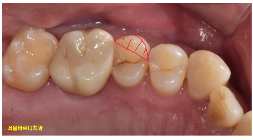 풍산동 치과 어금니 쪼개짐 임플란트를 해야할 때는? 관련 이미지 7