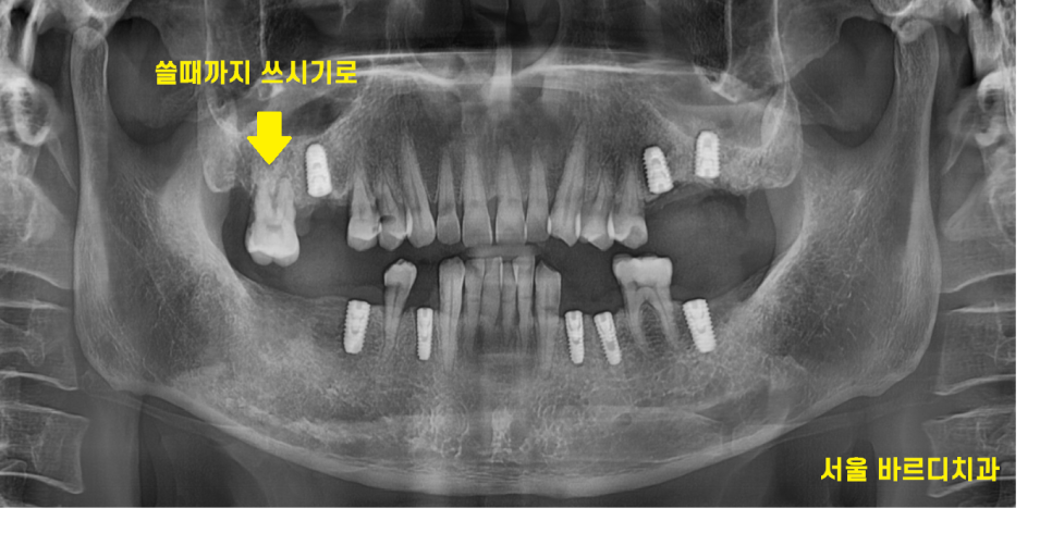 망월동 치과 어금니 빠짐 임플란트 대안이 될 수 있습니다. 관련 이미지 7