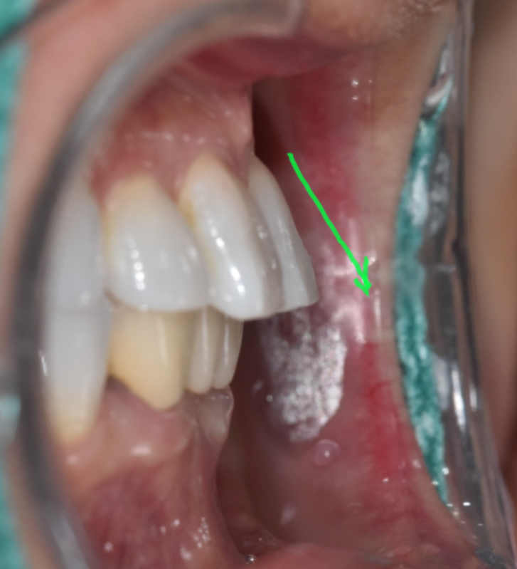 Solved My Concerns About Protruding Front Teeth with Partial Re-orthodontic Treatment of the Front Teeth image 3