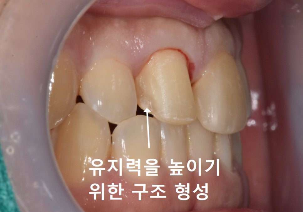 앞니 라미네이트 교체, 재시술 전 꼭 알아야 할 실패를 줄이는 방법 관련 이미지 11