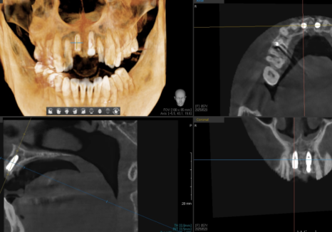 잇몸 까매짐 원인,증상,치료 방법 오래전에 앞니 씌운 곳 잇몸이 까매졌어요. 관련 이미지 9