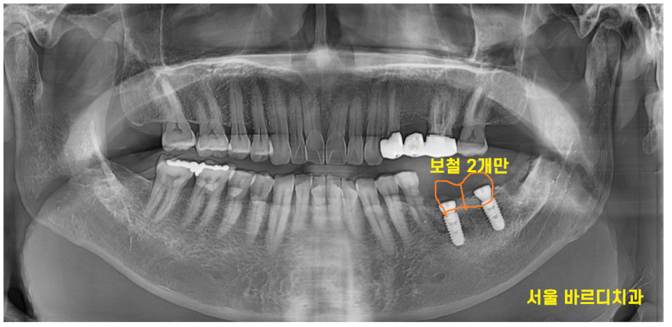 강일동 임플란트 씌운 치아 통증 불편할 때는 치과를 방문해주세요 관련 이미지 6