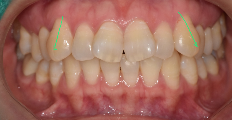 나비 모양 앞니 2가지 방법으로 개선 가능합니다. 관련 이미지 7