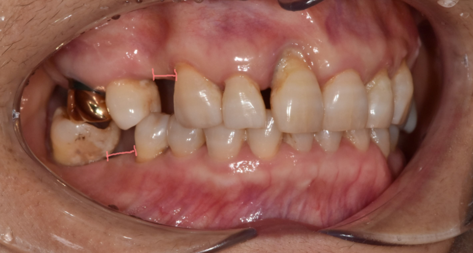 임플란트 불가능한 경우 3가지 경우는? 관련 이미지 4