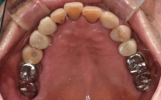 타치과 임플란트 as 수리 가능한 선동치과 관련 이미지 9