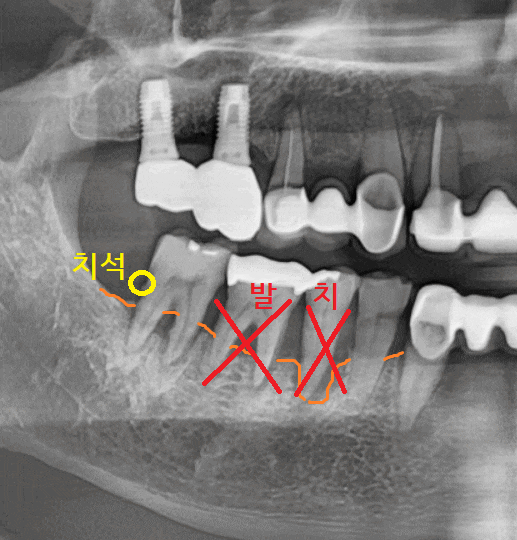 명일역 치과 움직이는 치아 치료 고정할 수 있을까? 관련 이미지 1