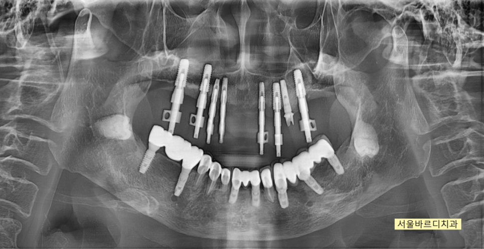 상일동 치과 부분 틀니에서 임플란트 바꿔서 사용하기 관련 이미지 10