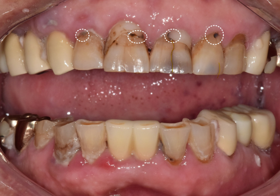 앞니 음식물 끼임, 왜 젊을 때보다 더 자주 발생하는 걸까요? 까맣게 변한 앞니 치료 사례 관련 이미지 4