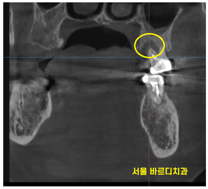 고덕동 치과 어금니 흔들림과 통증 임플란트가 답일 때! 관련 이미지 4