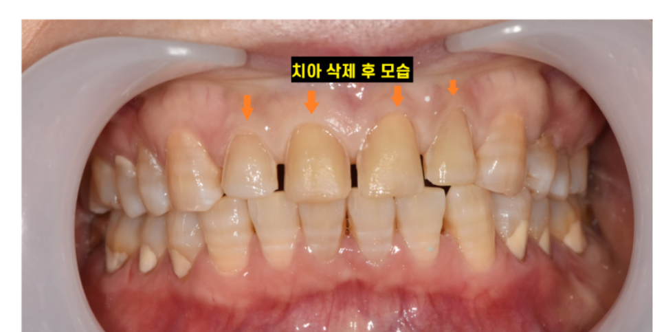 벌어진 앞니 치아 교정 통해 공간 닫기 장점이 많습니다. 관련 이미지 3