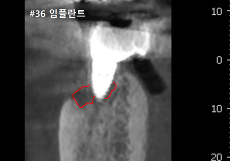 상일역 임플란트, 음식물 끼는 이유, 처음엔 안 그랬는데 왜 점점 심해지는 걸까요? 관련 이미지 8