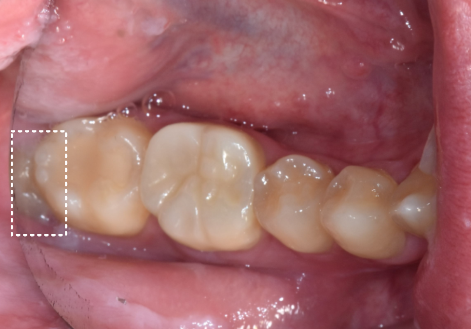 고덕동 사랑니 매복 발치, 안 아픈데 꼭 빼야 하나요? 관련 이미지 1