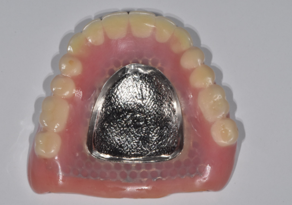 상일동 근처 치과 얇은뼈 틀니 안될 때 해결 방법은?? 관련 이미지 4