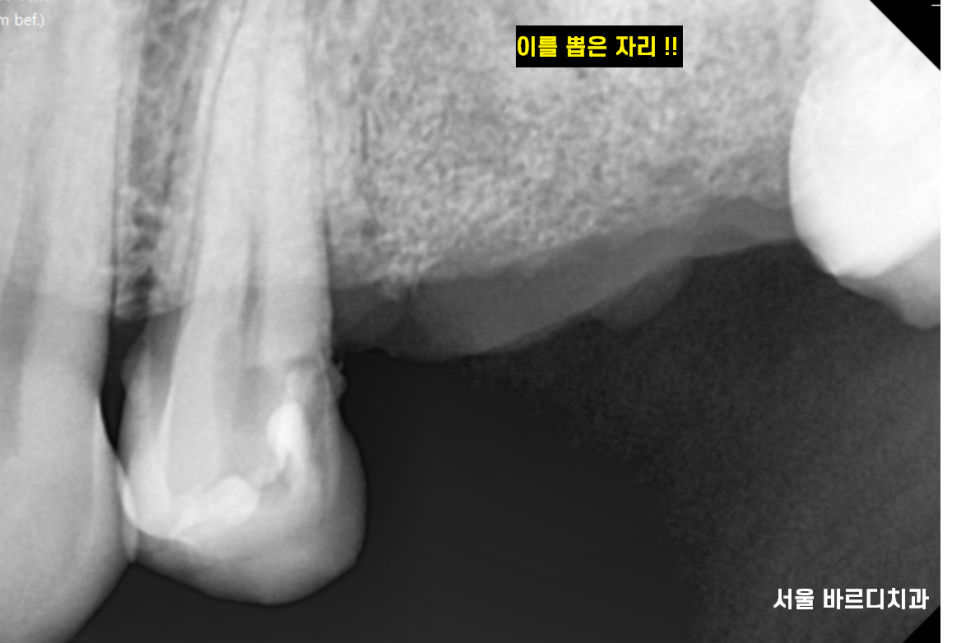 덕풍동 치과 씹을때 통증 임플란트로 극복했습니다. 관련 이미지 7