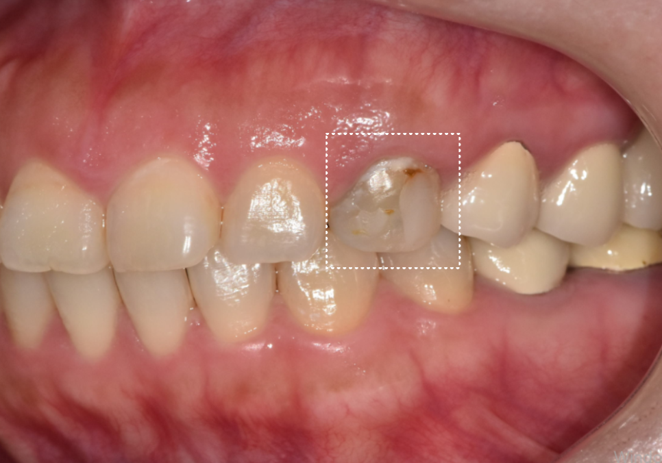 앞니가 검게 변색된 이유, 신경치료 후 꼭 크라운으로 씌워야 하는 걸까요? 관련 이미지 4