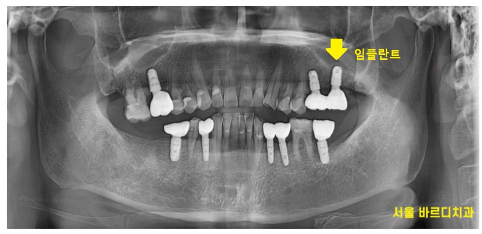 서울 임플란트 병원 선택 전 체크해야할 사항 고민은 이제 그만~ 관련 이미지 2