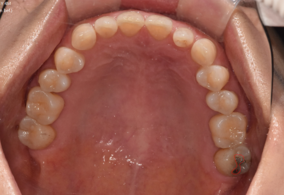 상일동역 치과 추천 임플란트 과정에서 제일 중요한 이것! 관련 이미지 4