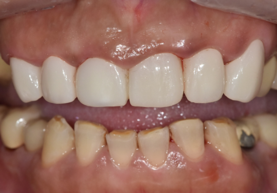 강동구 오래된 보철, 교체 시기는? 아프지 않은데 꼭 바꿔야 하나요? 관련 이미지 16