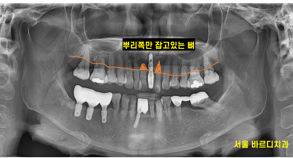 상일동역 치과 윗니 앞니 흔들림 임플란트로 심미까지 잡았습니다. 관련 이미지 3